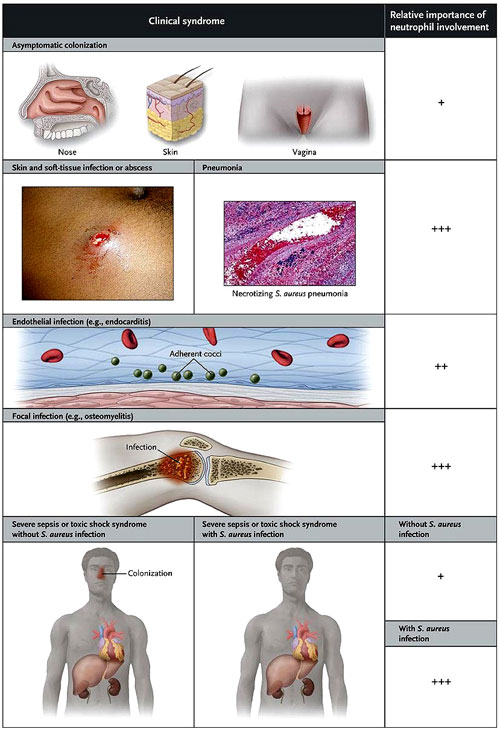 Figura 2: <em>Staphylococcus aureus</em> y síndromes clínicos