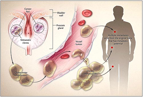 Figura 1: origen monoclonal de las metástasis del cáncer de próstata