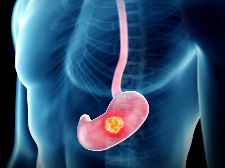 cáncer gástrico, Helicobacter pylori, trastuzumab, zolbetuximab