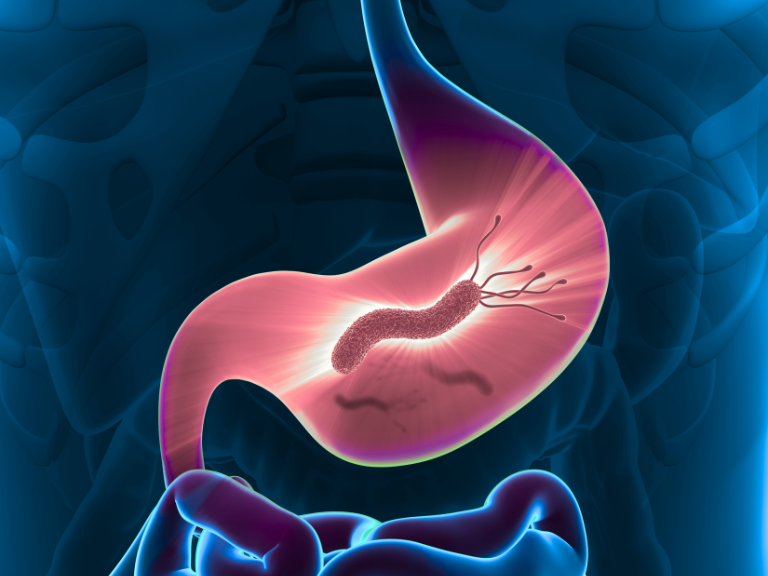 H. pylori, Helicobacter pylori, gastritis, cáncer gástrico, P-CAB, IBP, terapia cuádruple con bismuto