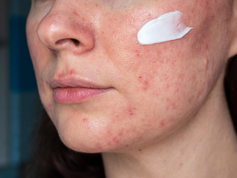 rosácea, tratamientos tópicos para rosácea, ivermectina tópica, peróxido de benzoílo encapsulado, metronidazol tópico, minociclina, ácido azelaico