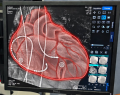 arritmias cardíacas, tratamiento de arritmias, cateterismo cardíaco, estudio electrofisiológico cardíaco, ablación por catéter, ablación cardíaca, electrofisiología cardíaca, trastornos del ritmo cardíaco, cardiología, atención cardiológica especializada, procedimientos de alta complejidad, SOLCA Chimborazo, Unidad Oncológica de SOLCA Chimborazo, Riobamba, Chimborazo, Ecuador, Diego Egas, Javier Rodríguez, Dennys Pinguil, implante de marcapasos, tratamiento mínimamente invasivo