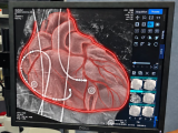 arritmias cardíacas, tratamiento de arritmias, cateterismo cardíaco, estudio electrofisiológico cardíaco, ablación por catéter, ablación cardíaca, electrofisiología cardíaca, trastornos del ritmo cardíaco, cardiología, atención cardiológica especializada, procedimientos de alta complejidad, SOLCA Chimborazo, Unidad Oncológica de SOLCA Chimborazo, Riobamba, Chimborazo, Ecuador, Diego Egas, Javier Rodríguez, Dennys Pinguil, implante de marcapasos, tratamiento mínimamente invasivo