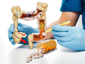 cáncer colorrectal, ácido acetilsalicílico, recurrencia de cáncer colorrectal