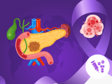 cáncer de páncreas, adenocarcinoma ductal pancreático,remisión del cáncer de páncreas 